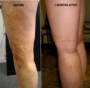 Varicose Vein Example 3